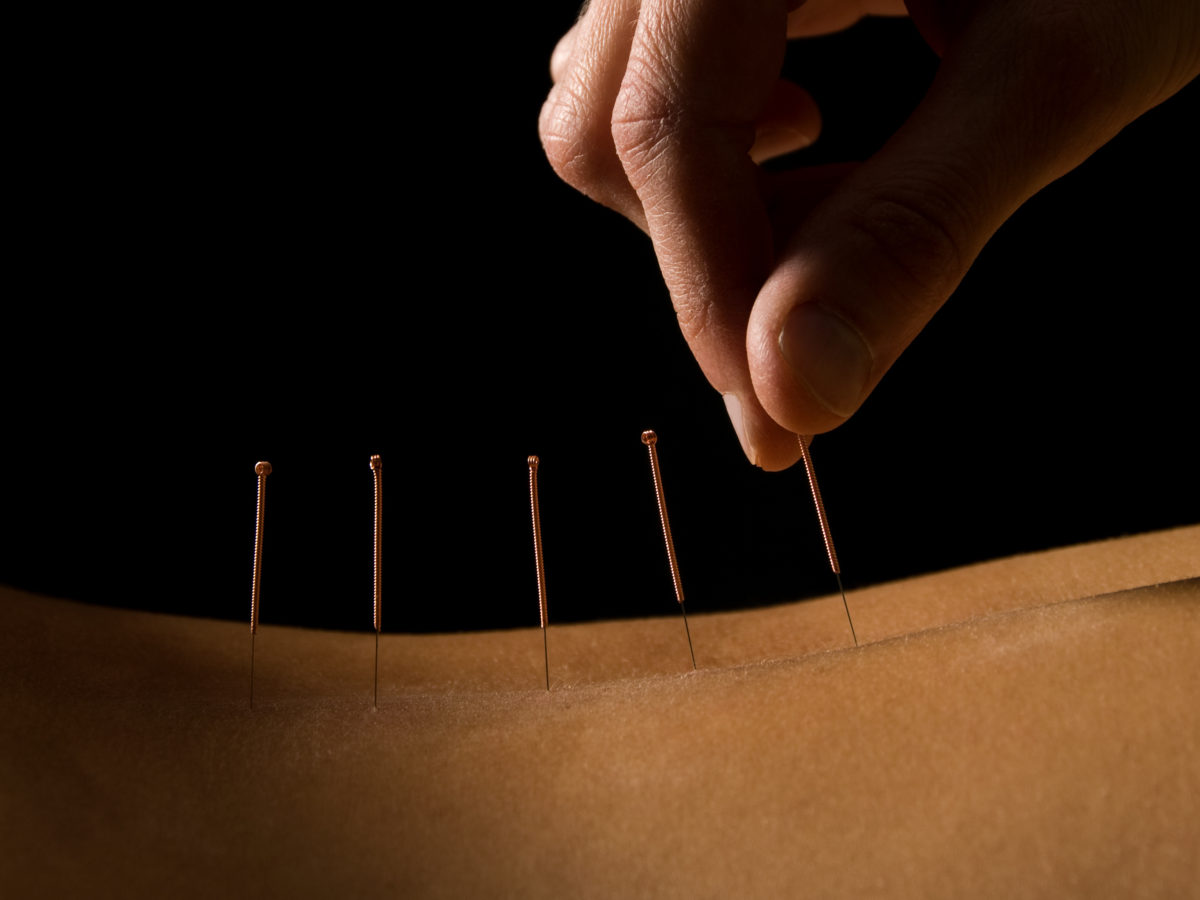 acupuncture